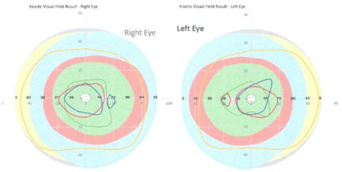 A diagram of What is a Kinetic Colour Visual Field at Buck & Todd Optometrist Mackay