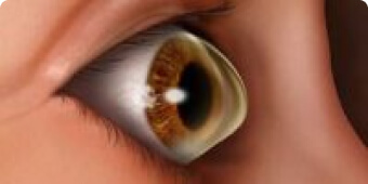 Keratoconus Eye Condition