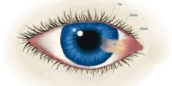 Pterygium Eye Condition